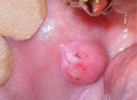 Fibroma Mucosa Geniana