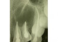 Lesão Cística no Ápice dos Dentes