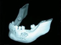 Osteocondroma Côndilo