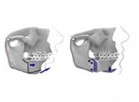 Osteotomia Sagital