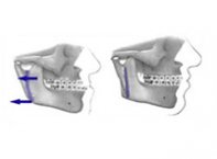 Osteotomia Vertical