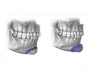Osteotomia do Mento