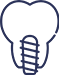Implantes Dentários